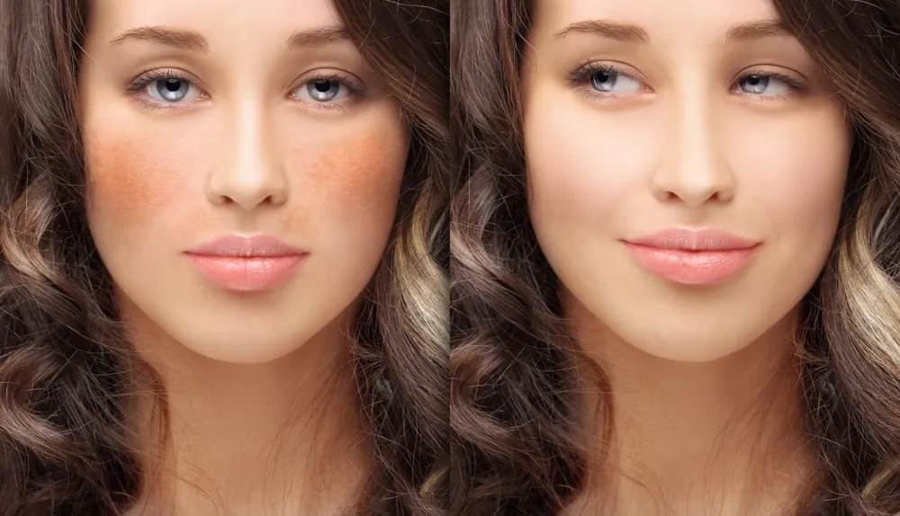 Pigmentation and Face-Mediterranean Beauty